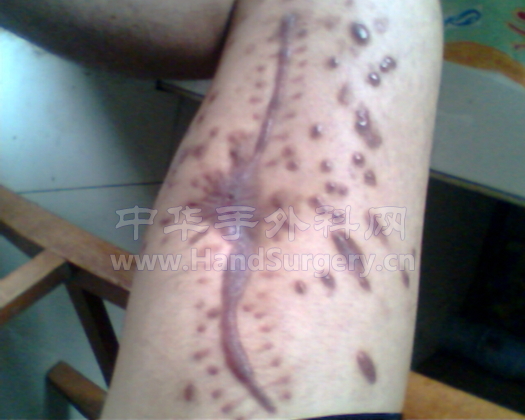 这是我现在的大腿伤口