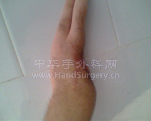 左手手术后现在的