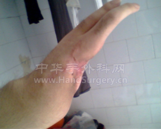 手术后现在的