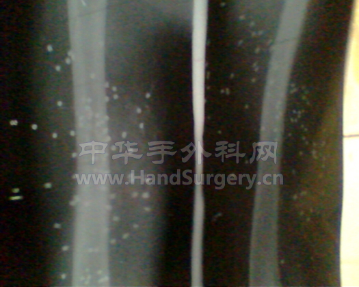 这是大腿手术后照的片子