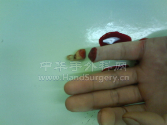 小指末节1型甲弓部离断