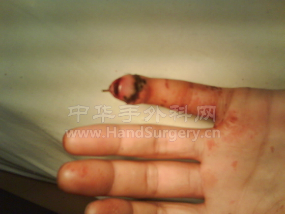 小指末节1型甲弓部离断