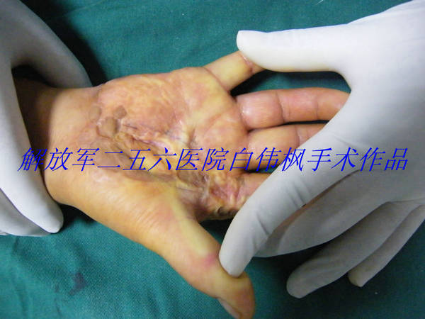 术前掌侧情况