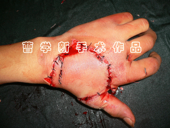术后1