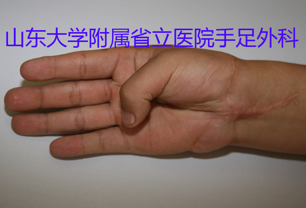 图2鱼际区外形丰满, 鱼际肌肌力5级副本.jpg