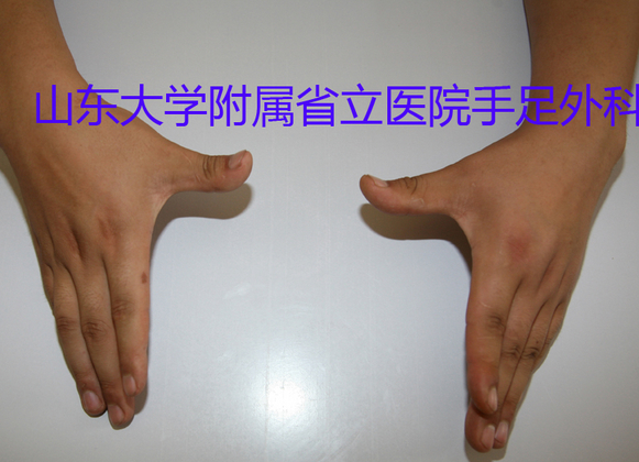 图3  拇指外展功能与健手相同。副本.jpg