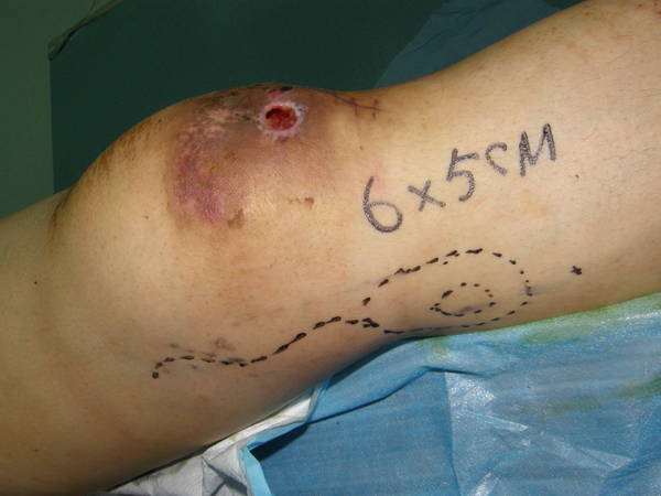 右膝降动脉皮瓣设计和髌前创面