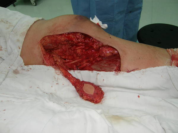 膝降动脉皮瓣切取