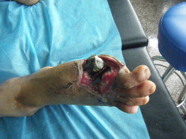 患者外伤后右足第一趾坏死，清创后骨外露