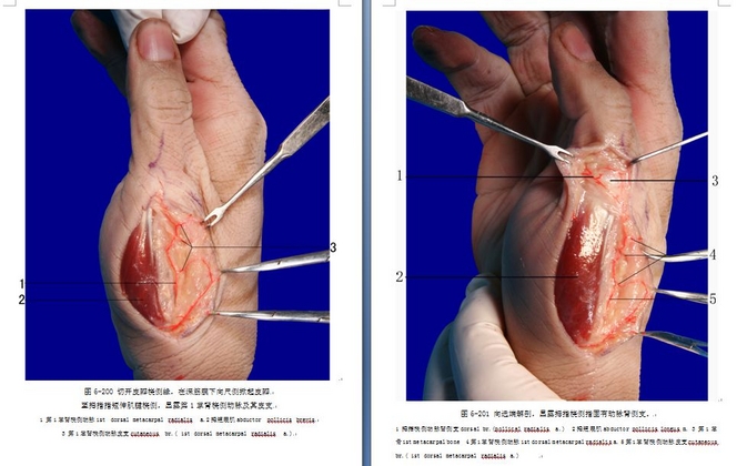 鱼际皮瓣解剖1.jpg