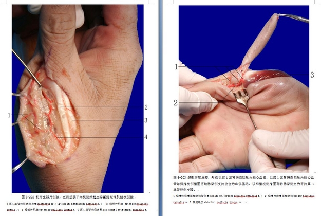 鱼际皮瓣解剖3.jpg