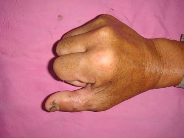 术后3个月零3天