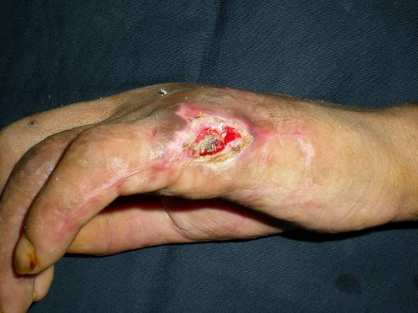 术后1.5个月，左手尺侧部分皮肤软组织坏死