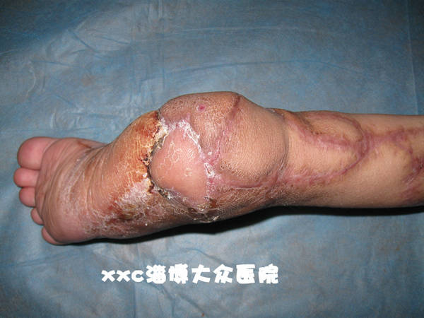 后期又做了个皮瓣
