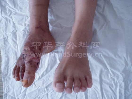 周丽术后4.JPG