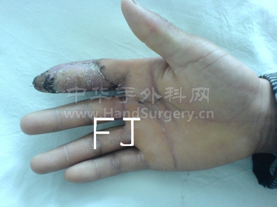 浙江省义乌市稠州医院手外科