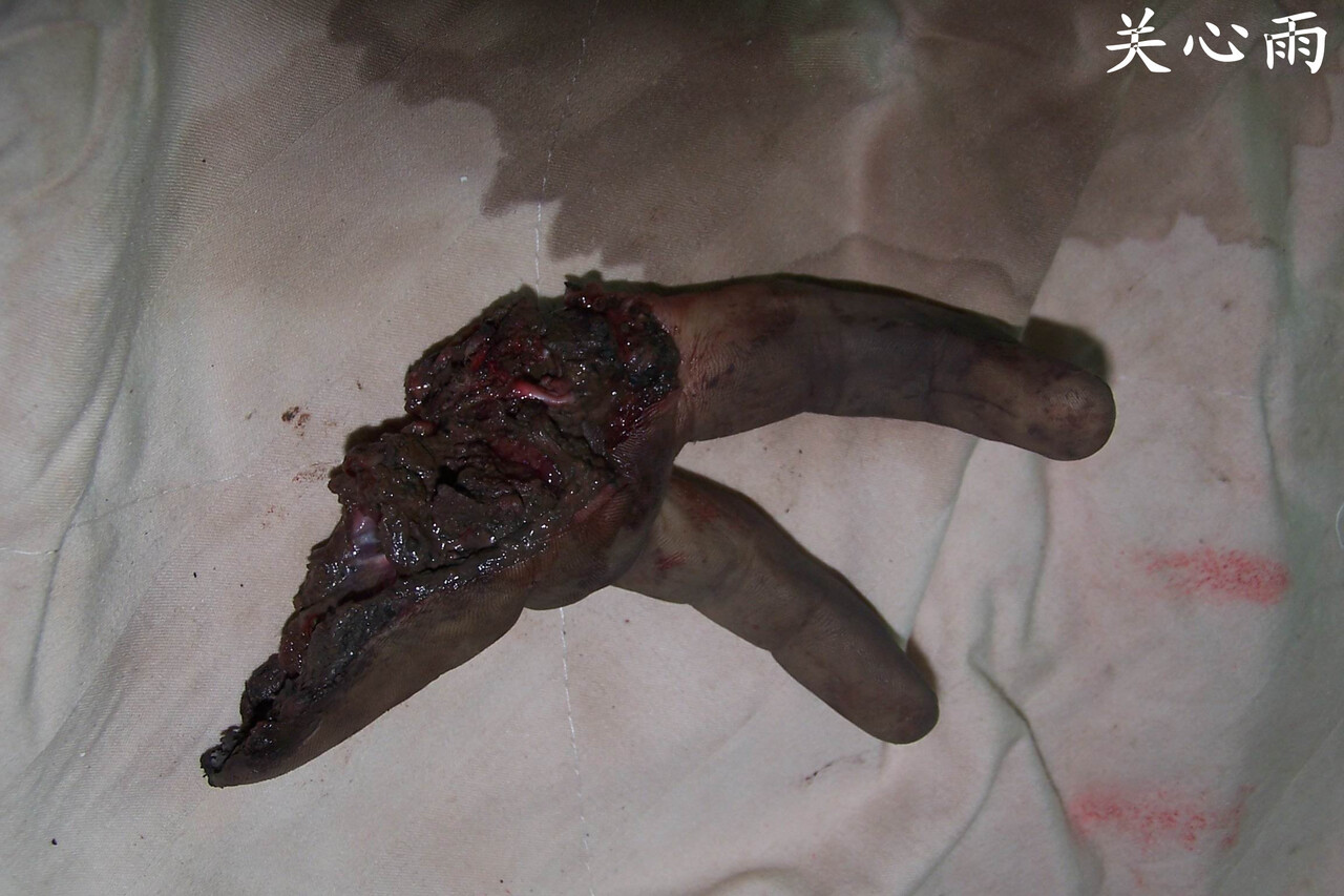 患者;李X,男,42岁,在煤矿上干活时被石头砸伤左手,致左手环小指完全离断,术中经桥接血.jpg