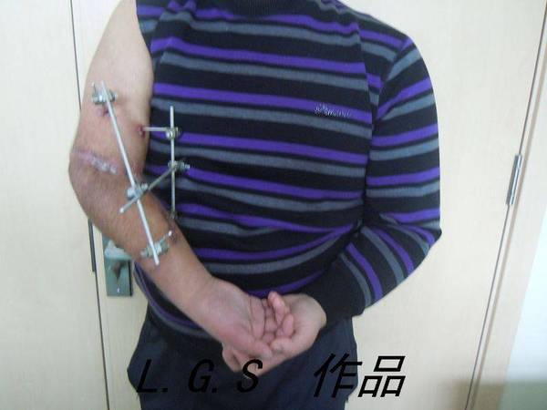 术后2月，出院时情况