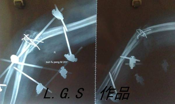 术后6月，当地医院摄片
