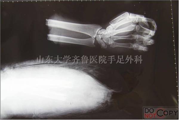 X片