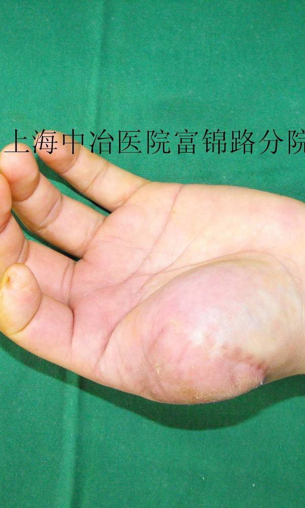 术中
