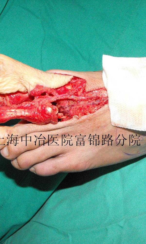 术中