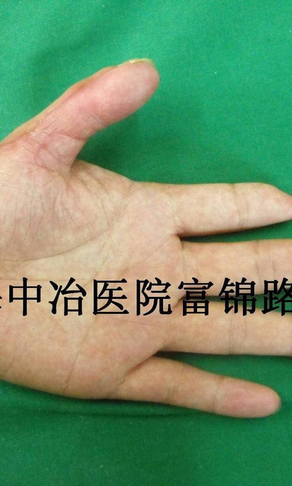 术后