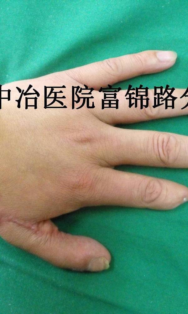 术后