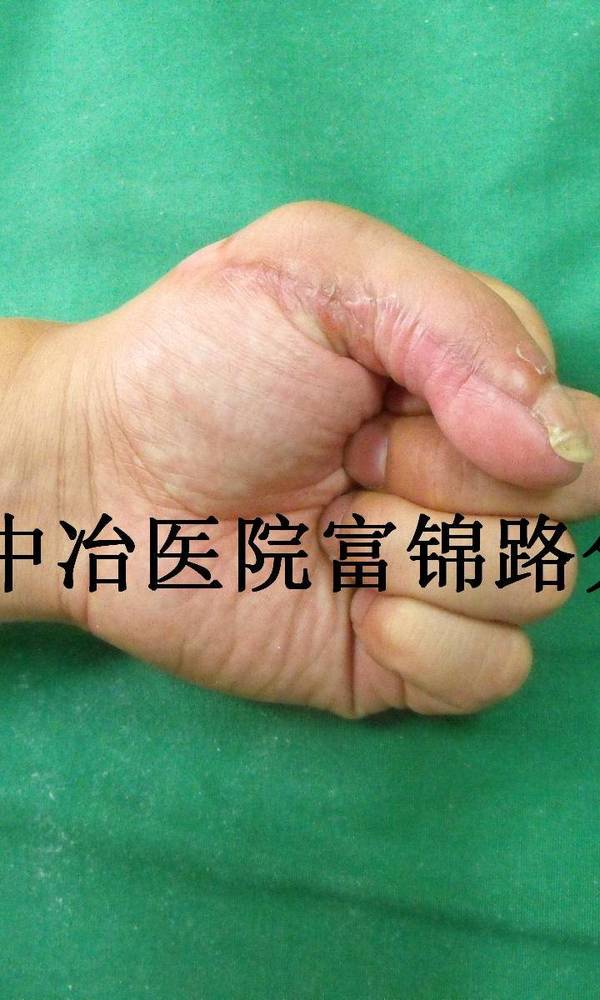 术后