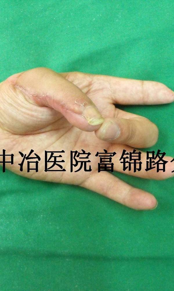 术后