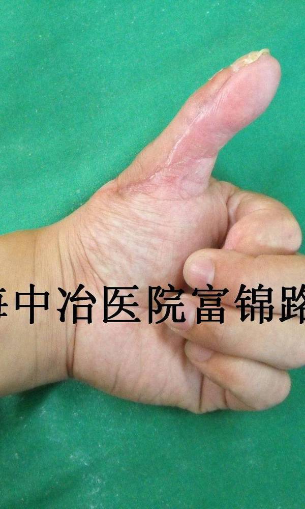 术后