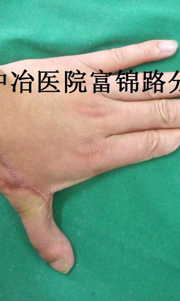 术后