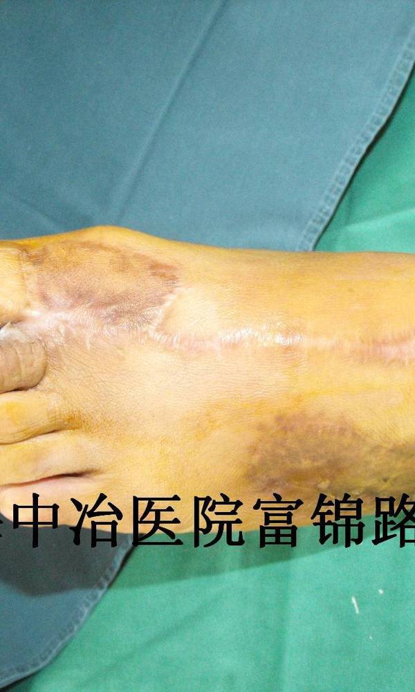 术后