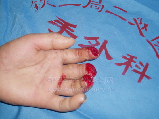食中环指末节缺如,环指残留一半甲床
