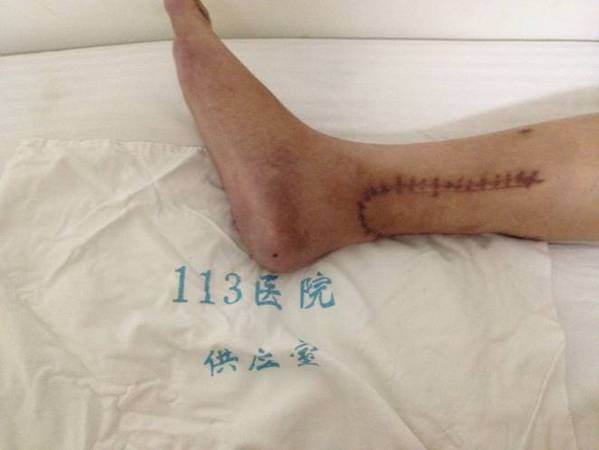 以下是左小腿毁损伤经过4次手术保肢成功图片20.jpg