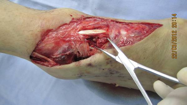 2个月前被重物挤压致伤，足背皮肤软组织剥脱，胫前动脉断裂