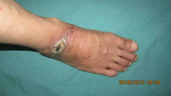 术后前踝部少许皮肤软组织干性坏死