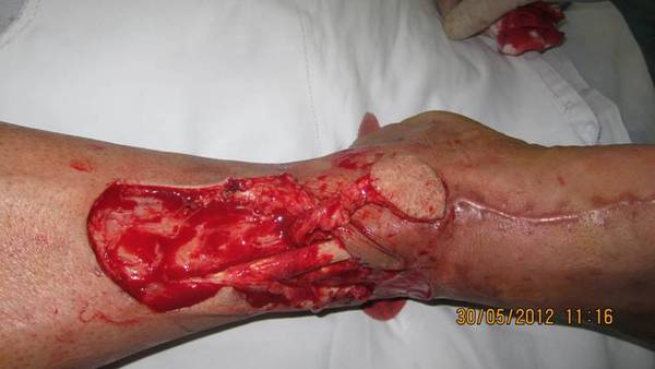切除坏死组织，松解皮下疤痕，创面外露，用前踝上皮瓣修复