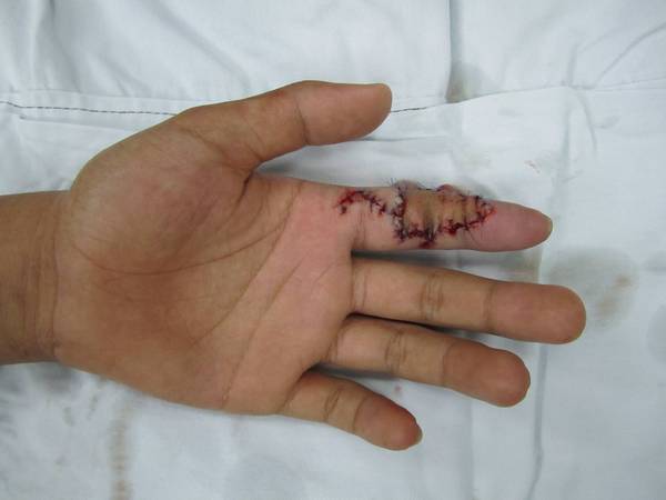 术中将骨间后动脉与示指桡侧指动脉吻合，