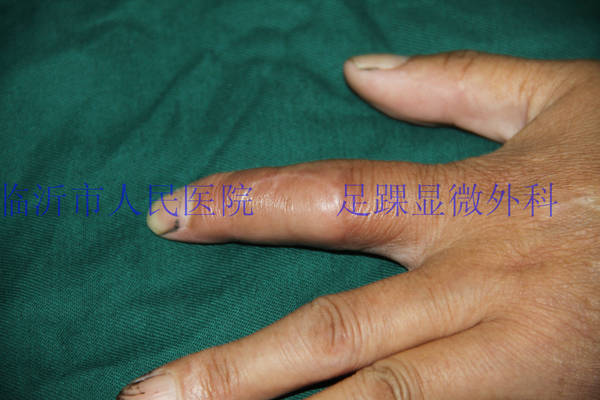 术后45天复查
