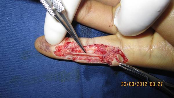 移植神经修复左示指桡侧指神经