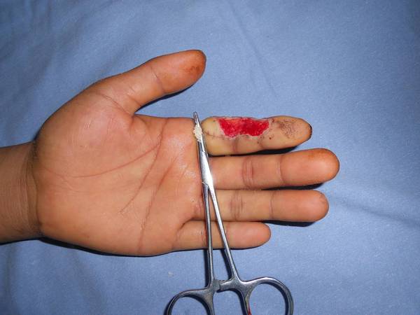 左示指皮耐克覆盖创面术后