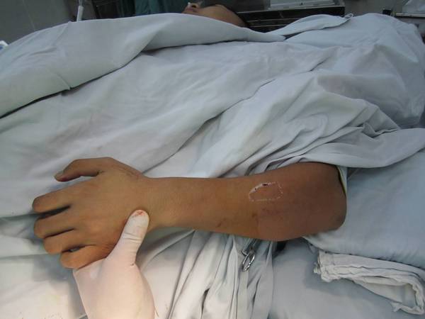 术中设计皮瓣（有点偏）