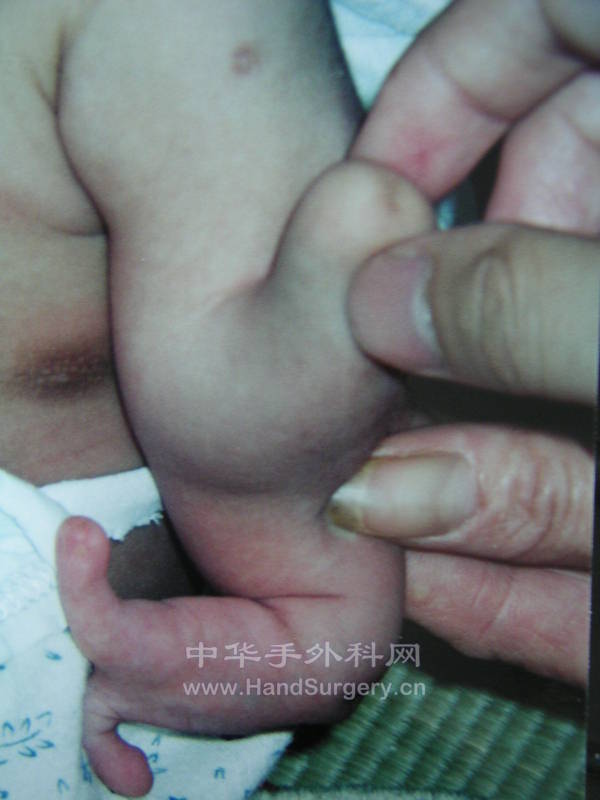 先天性分裂手伴桡骨移位上臂畸形