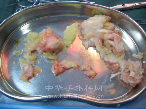 腕部肿物二十年逐渐增大，加重半年，病理炎性改变2.JPG