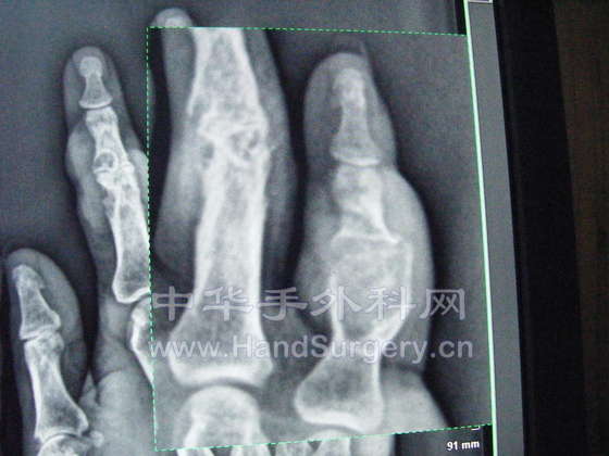 右小指DR放大图1.JPG