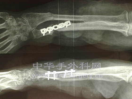 尺骨骨不连，遗憾！！！！！