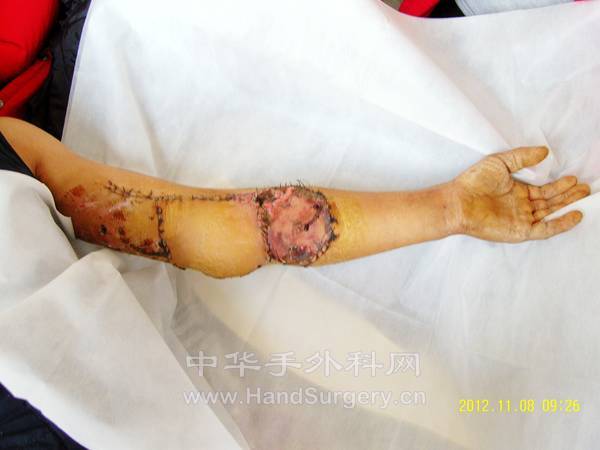 整体观术后第十二天1.jpg
