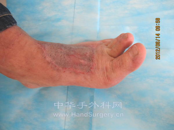 拇长伸肌腱无粘连