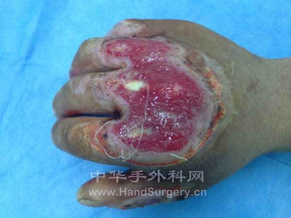 右手示中环指掌指关节及手背皮肤缺损